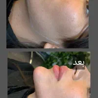 ژل و بوتاکس مطب دکتر حمید محمدزاده