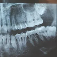 جرمگیری و بیلیچینگ و ایمپلنت