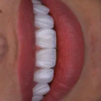 کامپوزیت ۶ماهه