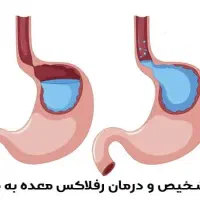 راهنمایی مشکل رفلاکس معده