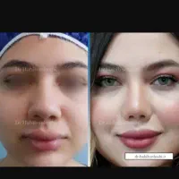 جراحی زیبایی بینی فقط با 40 میلیون تومان