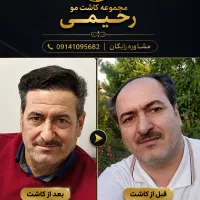 کاشت مو