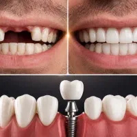 ایمپلنت تمام دیجیتال  اقساط دوساله بدون سود 16800