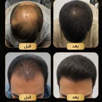 دیگ کچل نباش
