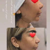 فشیال و پاکسازی و RF