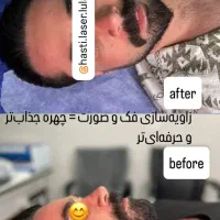 لیزر ۲۰۲۵ بدون درد فول 650 تضمینی+روشن شدن پوست