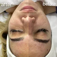 فیشال تخصصی و پاکسازی پوست