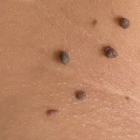 خالبرداری و حذف انواع زگیل با لیزر توسط پزشک