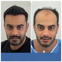 کاشت مو طبیعی و با ضمانت دائمی با تیم کامل پزشکی