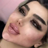 جشنواره تزریق ژل و بوتاکس فقط ۴۵۰