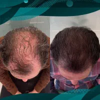 قبل اینک موهات شروع کنن مهاجرت اقدام کن