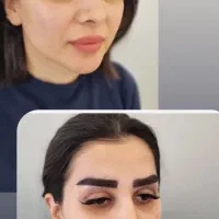 جشنواره تخفیف کاشت ابرو به روش لیفت  و کاشت مو