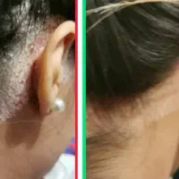 رفع  ریشه ای پسوریازیس  برای همیشه