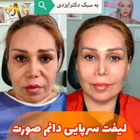 فیلر بادی، جراحی سرپایی زیبایی حجم دهی صورت بدن|خدمات آرایشگری و زیبایی|مرودشت, رودبال|دیوار