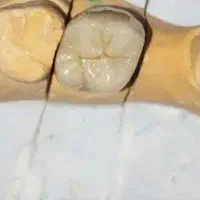 ساخت انواع روکش(لاابراتوار دندانسازی)