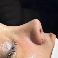 عمل جراحی بینی رینوپلاستی جراحی پلاستیک بلفارو