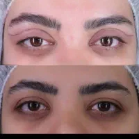بلفاروپلاستی پلک بالا و پایین،لابیا،غبغب