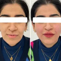 بوتاکس پیشانی و اخم ۹۹۹ژل کره ای۲/۴۰۰ توسط پزشک