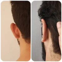 جشنواره تابستانه جراحی زیبایی گوش/اتوپلاستی|خدمات زیبایی و سلامت|تهران, آرژانتین|دیوار