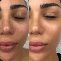 تخفیف بهاره پاکسازی تخصصی و فیشال صورت