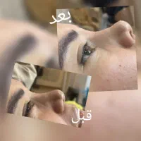تزریق ژل و بوتاکس مزو و مزوژل