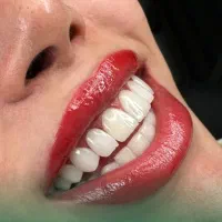 دندانپزشکی زیبایی دندان اقساط بلند مدت