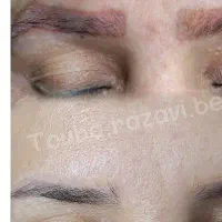 ریموو تتو و میکرو صورت و ابرو