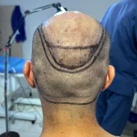 آموزش کاشت مو،ابرو و ریش