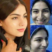 جراحی بینی با پیزوسرجری و نصف قیمت