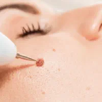 برداشت خال و ضایعات پوستی
