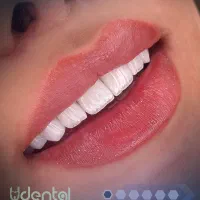 کامپوزیت لمینت ایمپلنت اقساط ویژه