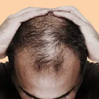 پک ضد ریزش مو