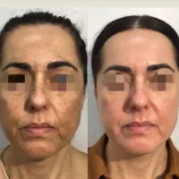 کرم بیوممتیک درمان قطعی لک‌های صورت