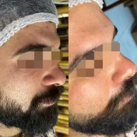 خدمات پاکسازی پوست و فیشال در خمین