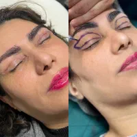 بلفاروبلاستی لیفت چشم پنچاه درصد تخفیف ۱۰/۹۰۰