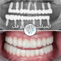 دندانپزشکی تخصصی ایمپلنت اوردنچر جراحی پیوند/اقساط