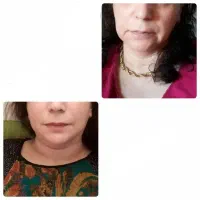 چاقی صورت