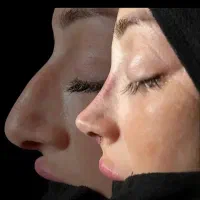 آفر ویژه  عمل جراحی بینی در کرج