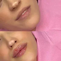 رفع خطوط به شکل طبیعی