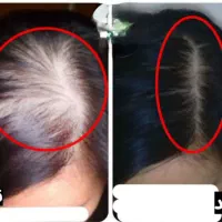 پک کامل قطع ریزش مو و رویش مجدد هیرفرند