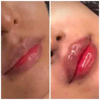 خدمات زیبایی ژل بوتاکس مزو فیلر