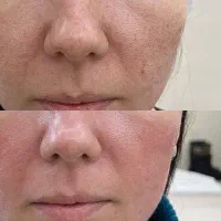 پاکسازی تخصصی پوست