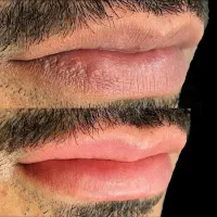 شیدینگ ورفع کبودی لب و بولدبروزابرو و‌میکرواسکالپ
