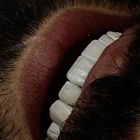 دندانپزشکی‌لمینیت روکش  کامپوزیت بریج اقساطی