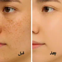 با کرم روشن کننده پوستت و روشن کن دیگه نگران نباش