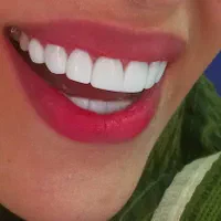 جشنواره یلدایی کامپوزیت دندان