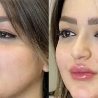 تزریق بوتاکس دیستون ۴۹۰ و مصپورت ۵۹۰ تا ۱۰ اسفند