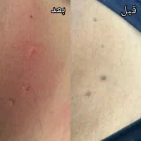 برداشتن خال زگیل میخچه باقیمت فوق العاده توسط پزشک