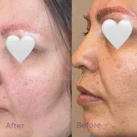 جوانسازی پوست صورت (تخفیف ویژه)