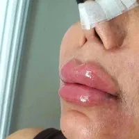 جشنواره تزریق ژل و بوتاکس فیلرلب فول فیس کانتورینگ